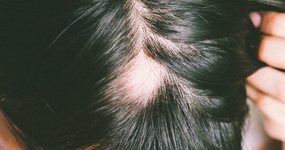 Calvície feminina com rarefação difusa na linha de divisão, couro cabeludo feminino mostrando padrão de queda gradual