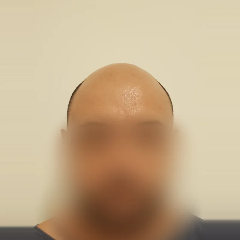 Antes do transplante capilar