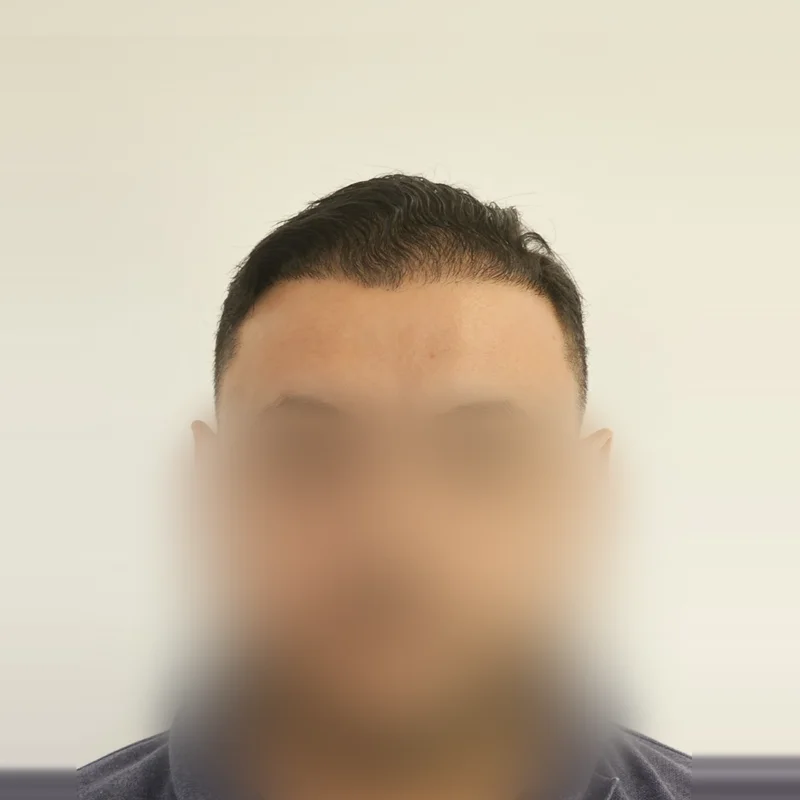 Depois do transplante capilar